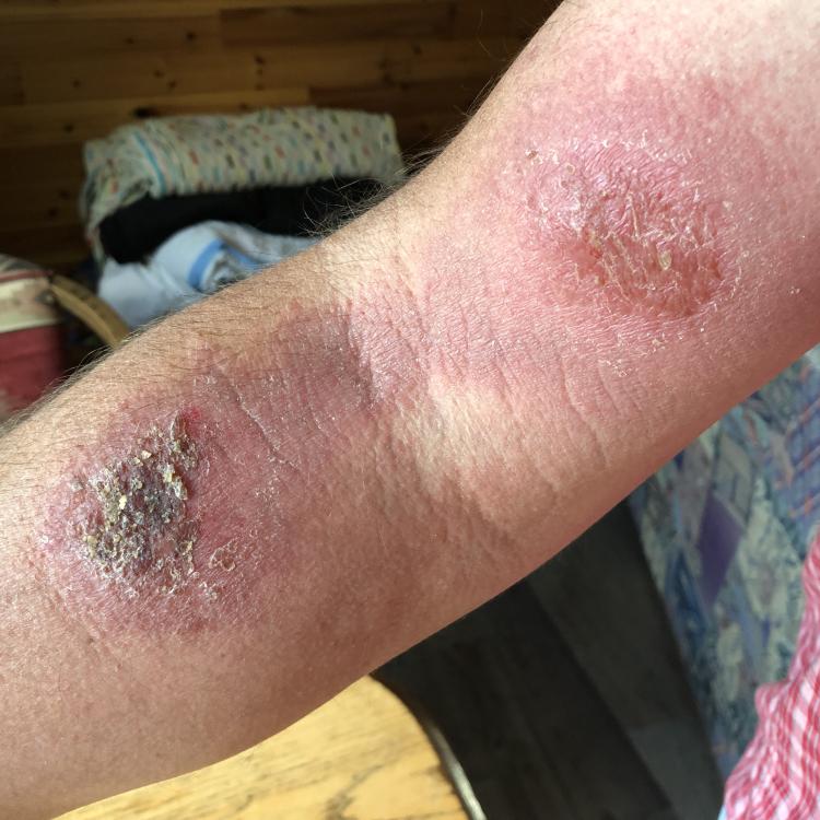 person's arm with rash